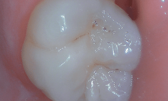 intraoral mode